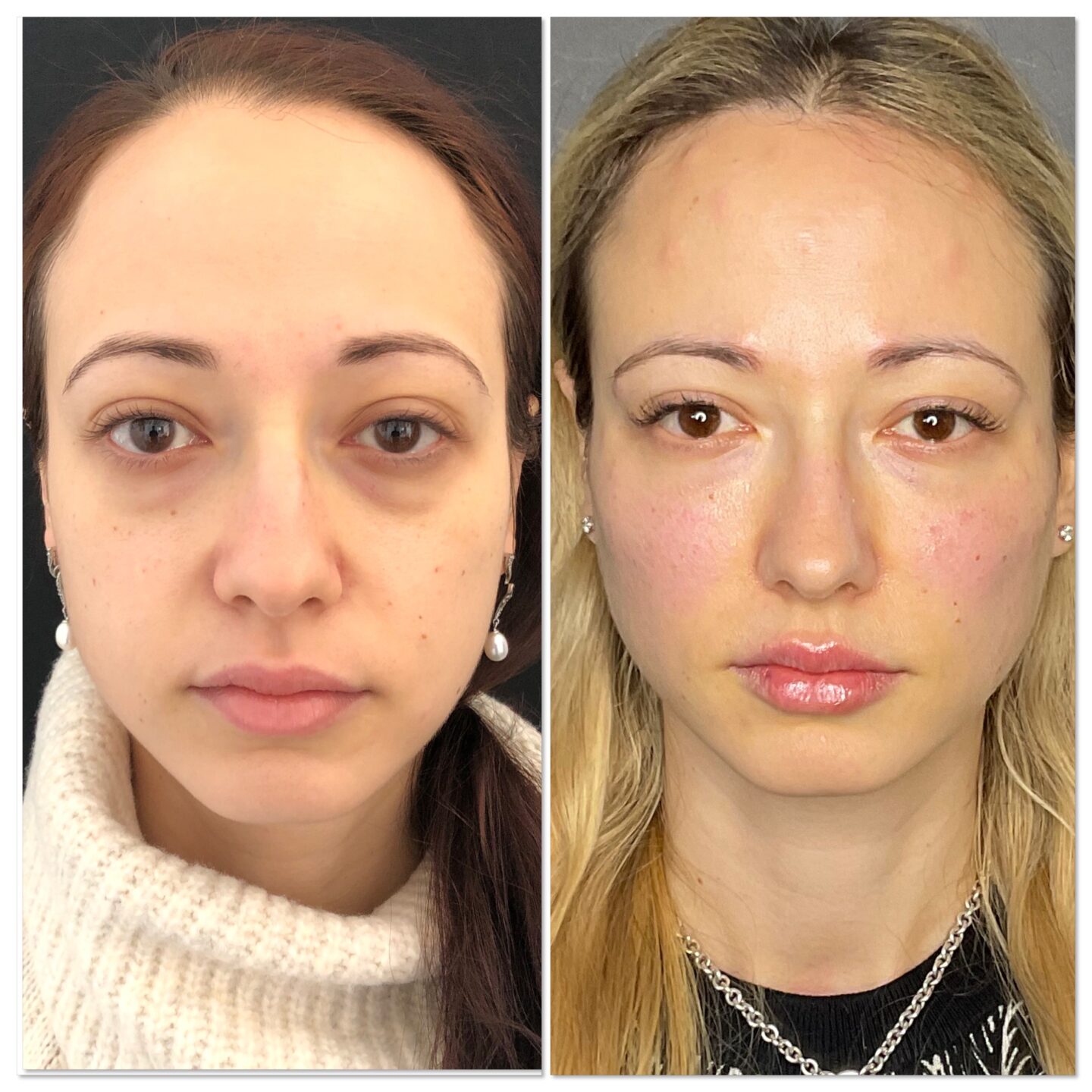 Cheek Fillers in Harley Street & Bromley | Dr Liesel Holler