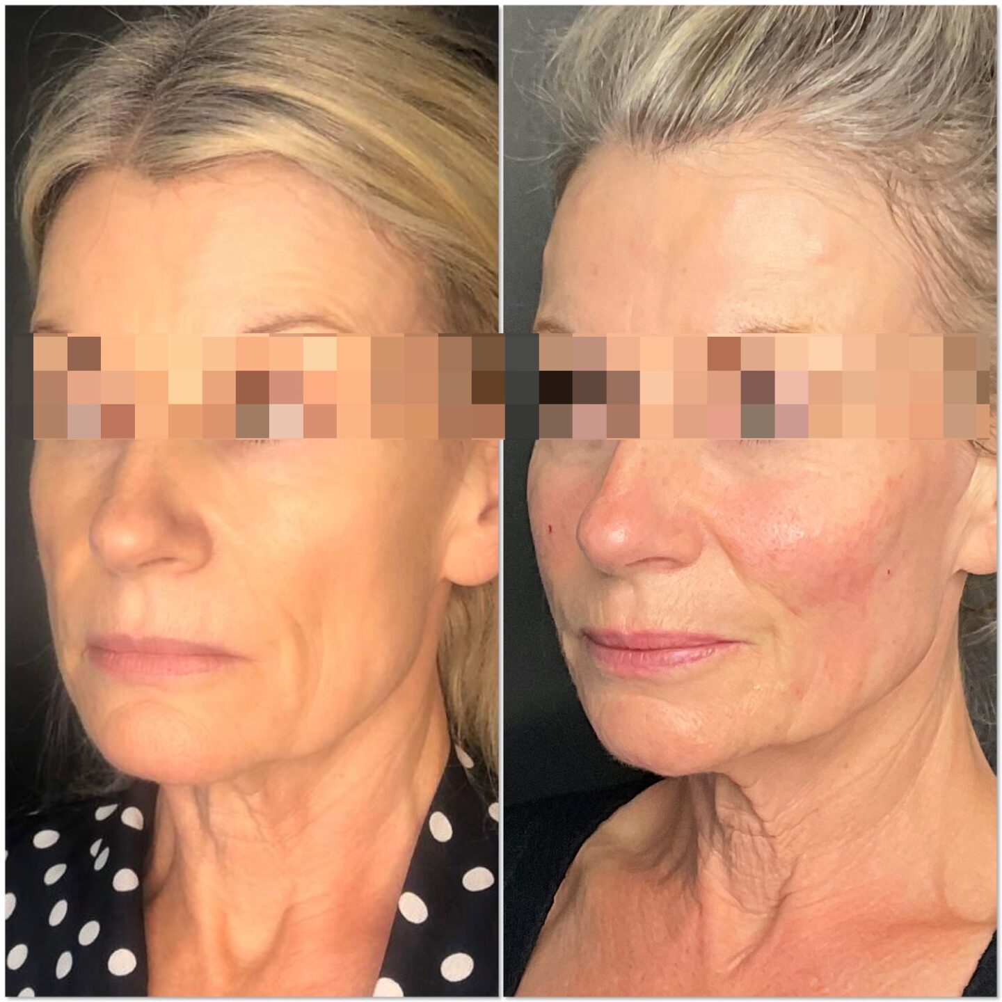 Cheek Fillers in Harley Street & Bromley | Dr Liesel Holler