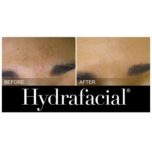 Hydrafacial Treatment- Liesel Holler - Chislehurst