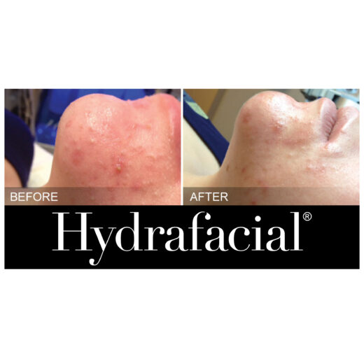 Hydrafacial - Liesel Holler - Chislehurst
