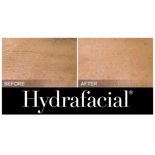 Hydrafacial for fine lines - Liesel Holler - Chislehurst