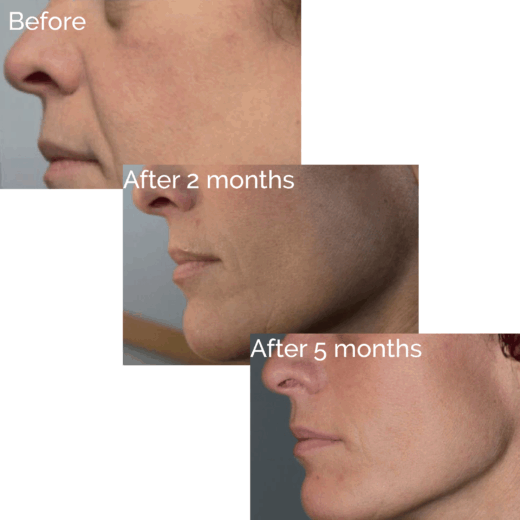 Rexonage®3 Before & After Treatment - Dr Liesel Holler
