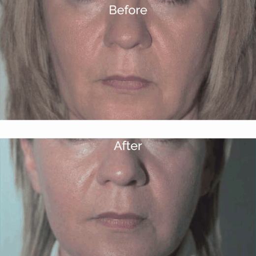 Rexonage - Before & After - Dr Liesel Holler