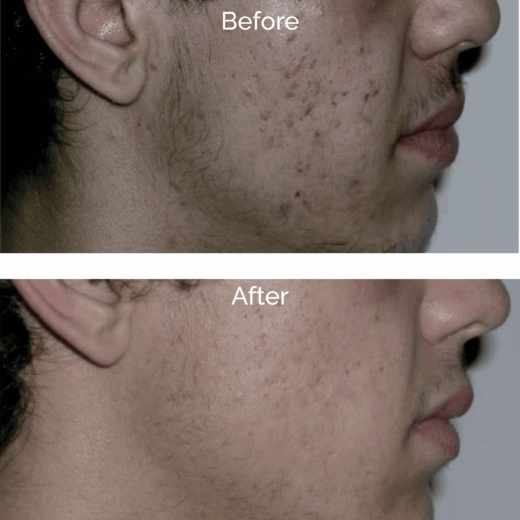 Rexonage Treatment - Before & After - Dr Liesel Holler