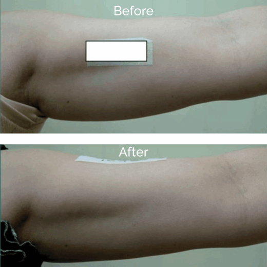 Rexonage - Before & After - Liesel Holler
