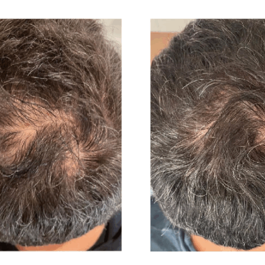 Tricopat Before and After at Liesel Holler in Chislehurst