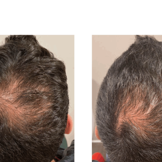Tricopat Before and After Results at Liesel Holler Clinic Kent