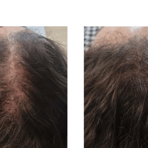 Tricopat Before and After Images Liesel Holler, Chisleburst