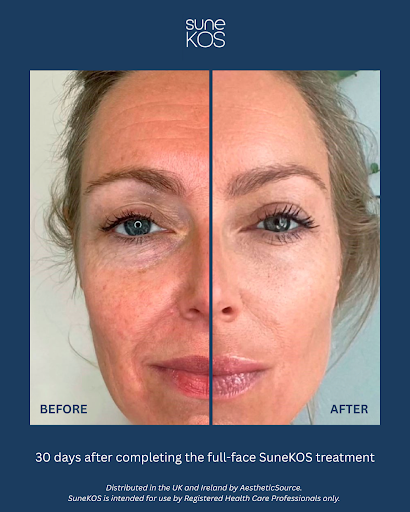 Sunekos before and after