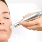 Microneedling treatment